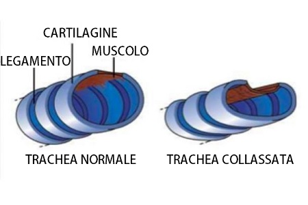 COLLASSO TRACHEALE