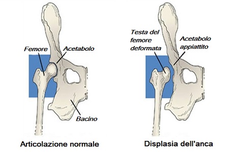 anca normale e con displasia